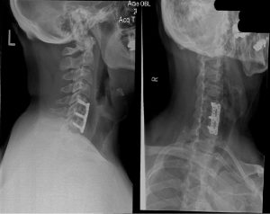 [OC] X-Ray after they fused my neck after they removed a ruptured disc that was paralyzing me.