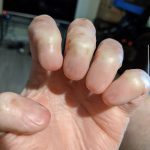 Anonychia is the partial or total absence of one or more nails on the fingers or toes.