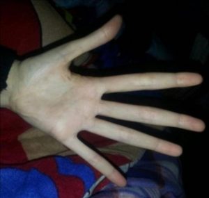 Here are my Marfan's syndrome hands.