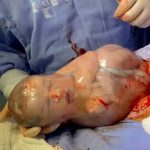 Baby born with amniotic sac still intact.