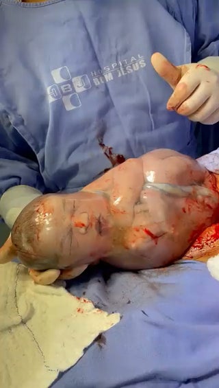 Baby born with amniotic sac still intact.