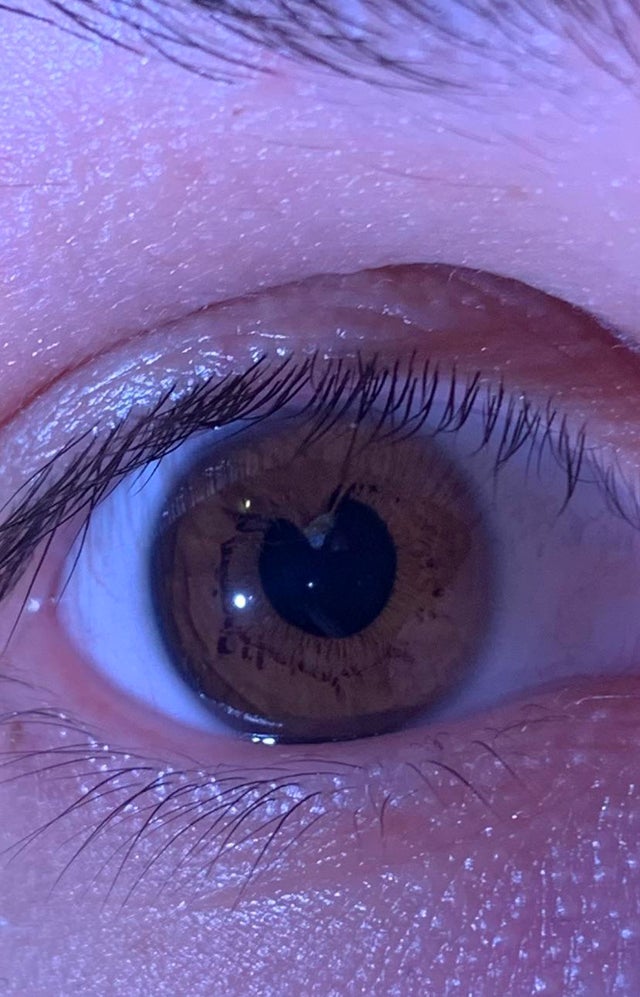 My right eye, it doesn’t cause any noticable sight problems