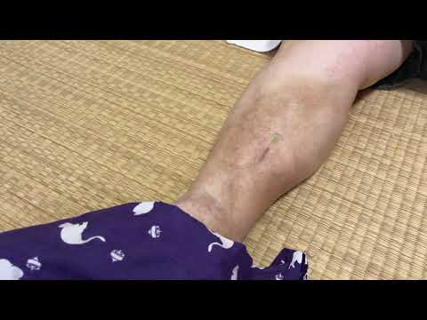 皮膚疾患もはりで治す　蜂窩織炎へのはり治療